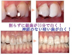 東京のホワイトニング専門歯科が行う歯のマニキュア