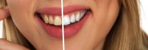 ホワイトニング前後の歯の比較