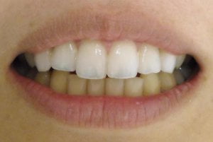上の歯と下の歯の色の違いをホワイトニングで白く