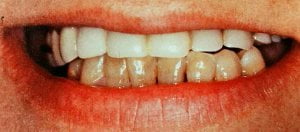 上下の歯の色が違っているホワイトニング前の状態