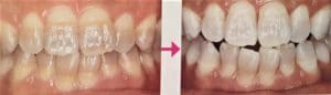 テトラサイクリン歯のホワイトニング例