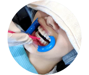 ホワイトニング後の痛み予防処置