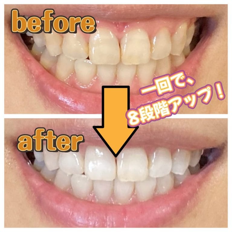マイスタープラスホワイトニングで１回で白い歯になった女性の歯