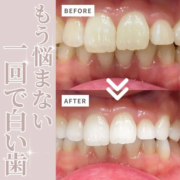 もう悩まない！1回で白い歯