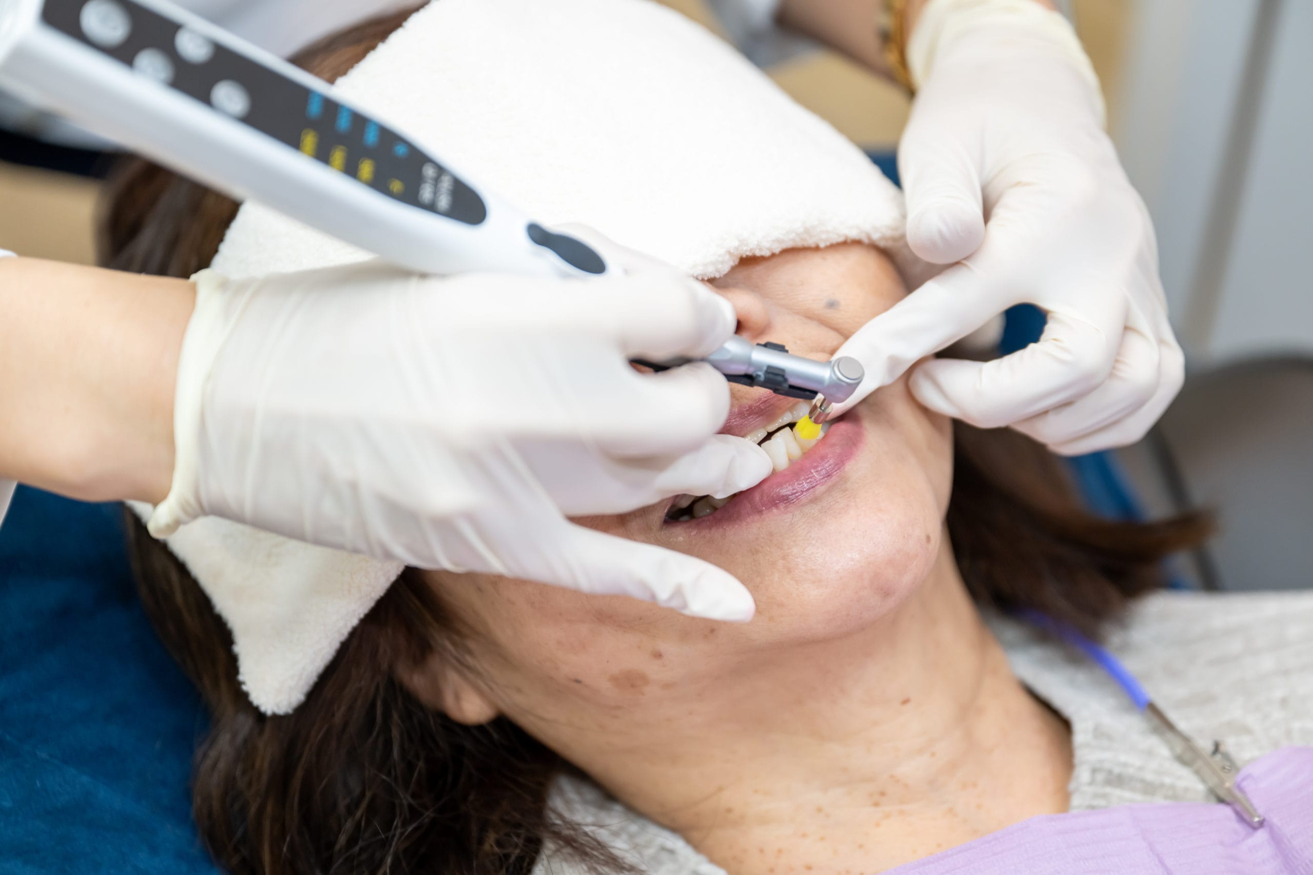 ホワイトニング前のクリーニング