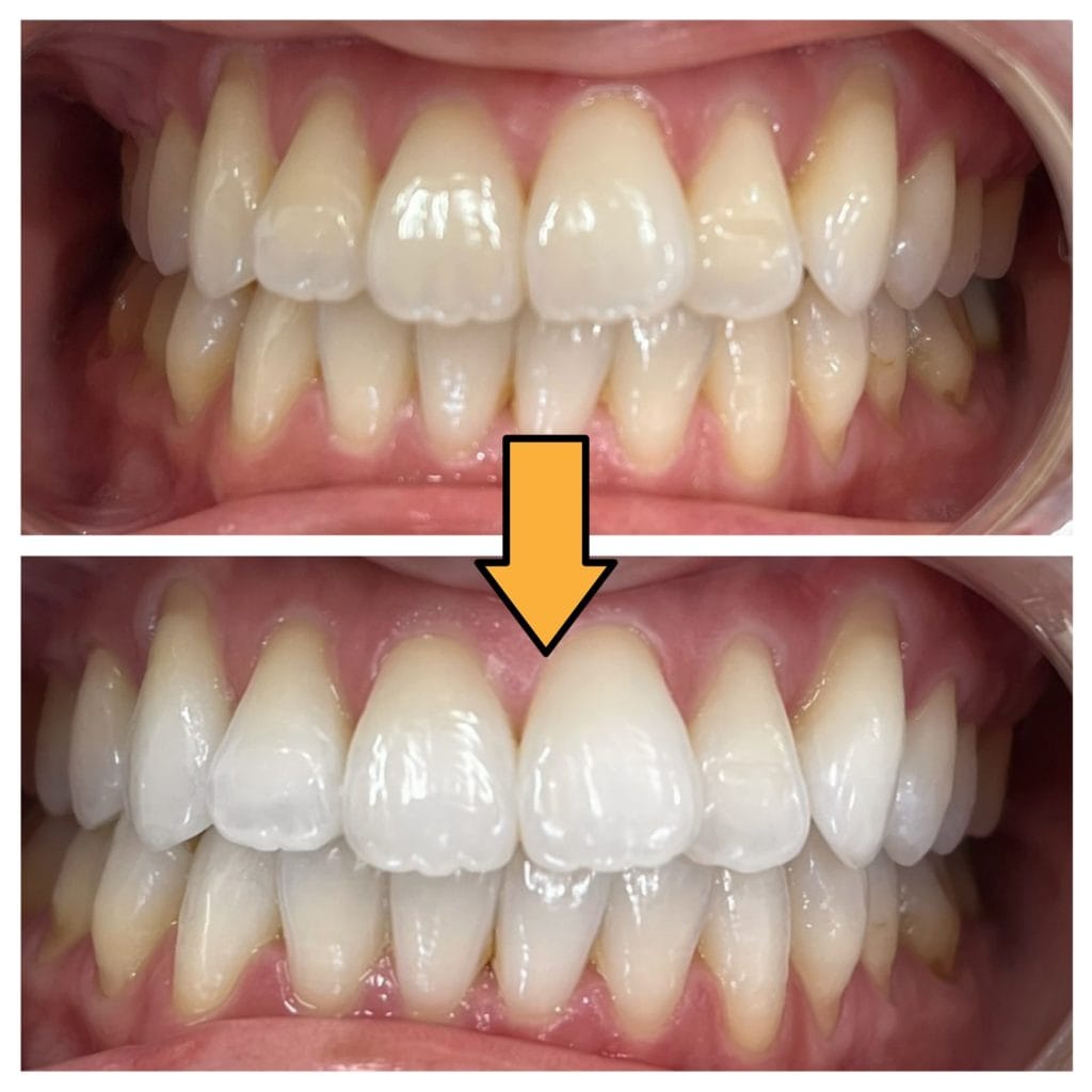 ホワイトマイスター東京銀座院でのオフィスホワイトニング１回の術前術後の変化
