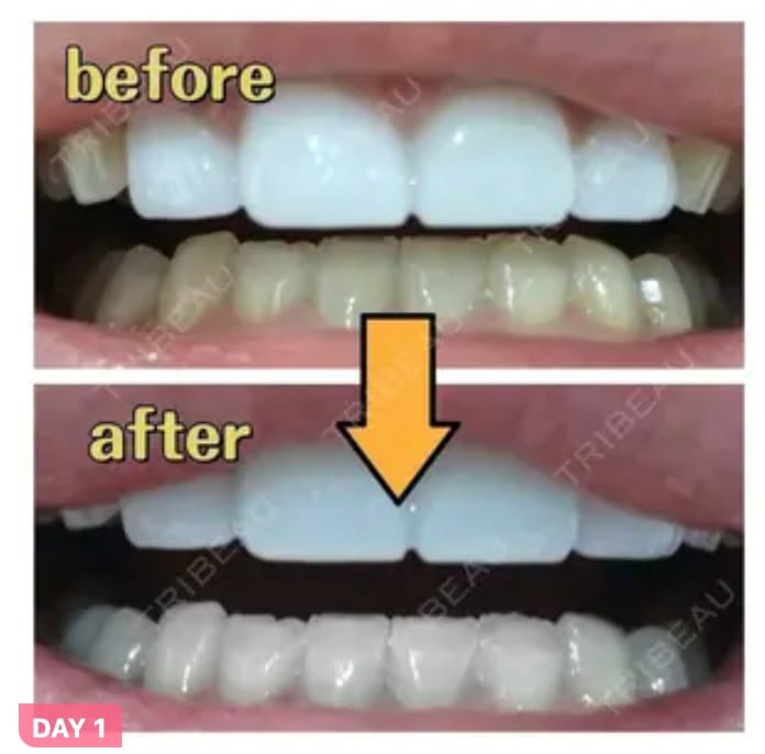 上の歯の色と下の歯の色が違うケースでホワイトニングで改善した例