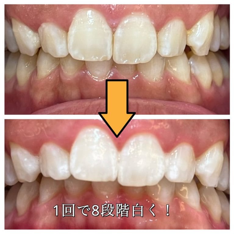 ホワイトマイスター東京銀座院のオフィスホワイトニング治療結果